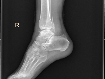 骨折脚踝外侧的骨头有裂口图.jpg