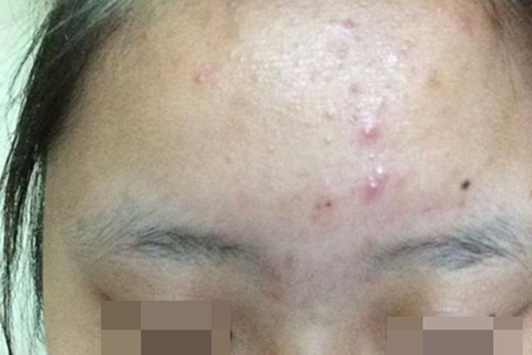 痤疮额头上小红疙瘩图 痤疮额头上小红疙瘩图