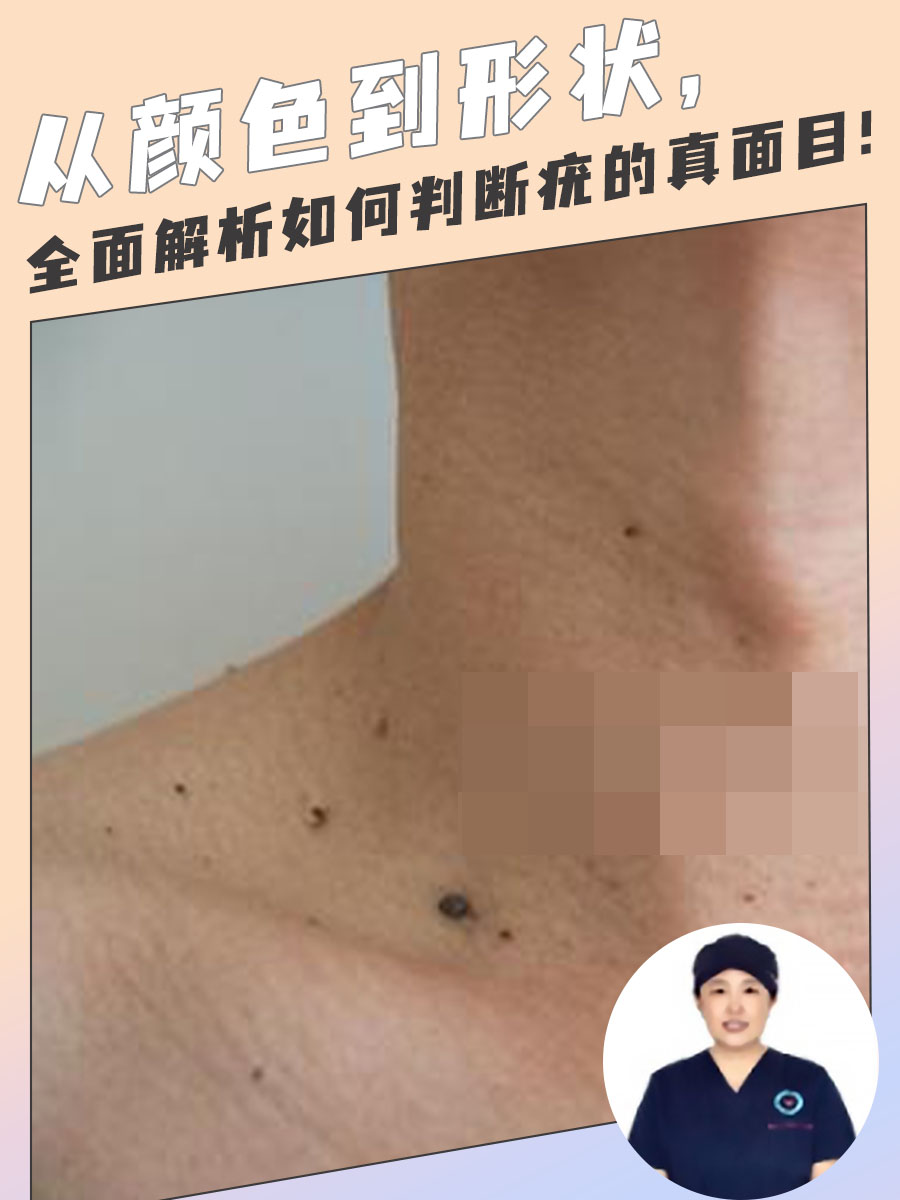 从形状到颜色，全面解析如何判断疣的真面目！