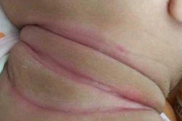 念珠菌性间擦疹红斑图