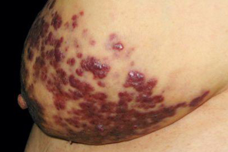 艾滋病晚期卡波西肉瘤图