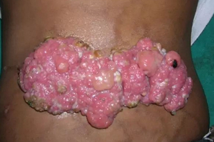 乳头状汗管囊腺瘤皮肤长瘤图