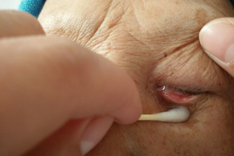 泪管发炎挤出黏液图