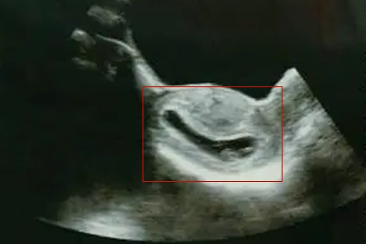 怀孕初期孕囊特别细长图