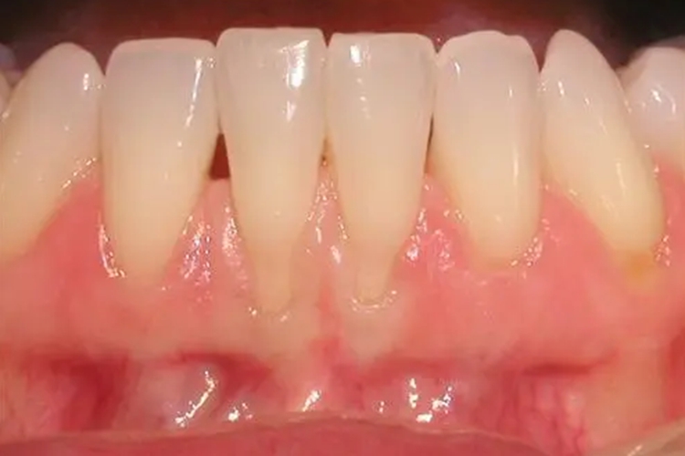 慢性苯中毒萎缩图 慢性苯中毒萎缩图