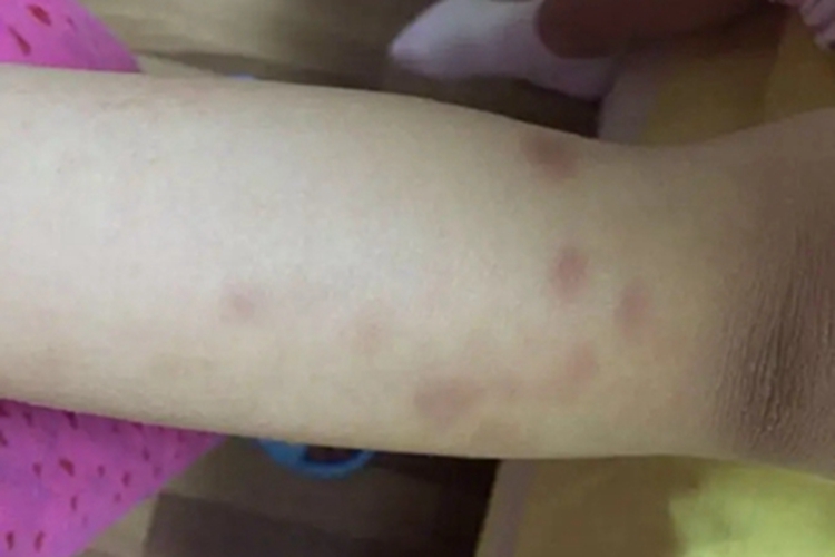 结节性脂膜炎胳膊红斑图 结节性脂膜炎胳膊红斑图