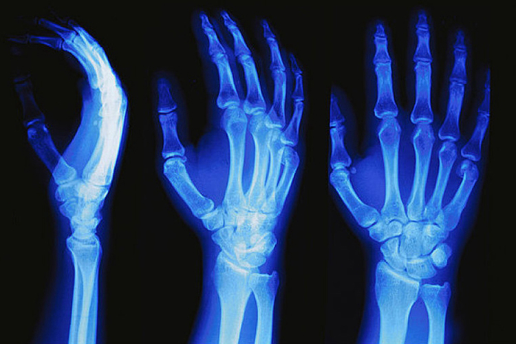 正常右手手腕X光片图 正常右手手腕X光片图