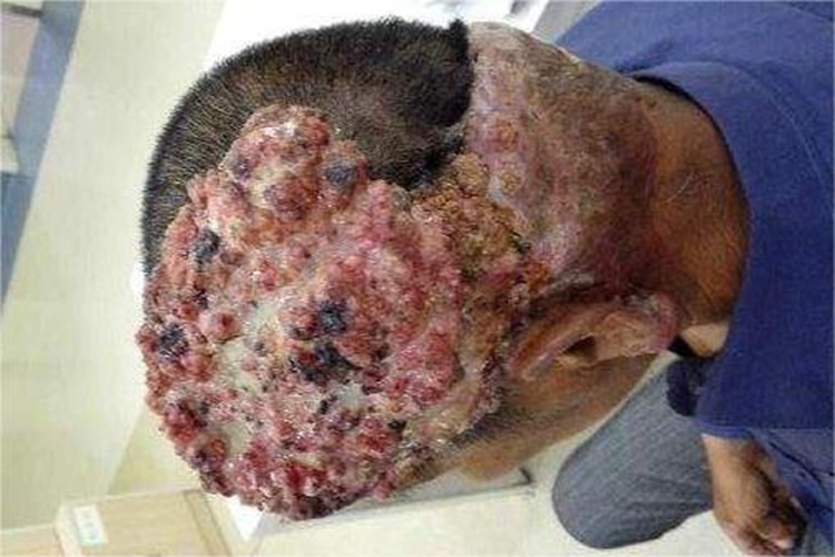 头部鳞状细胞癌症状图 头部鳞状细胞癌症状图