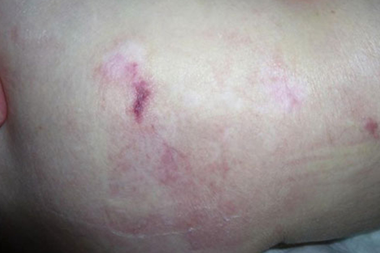 淤血红润期褥疮图