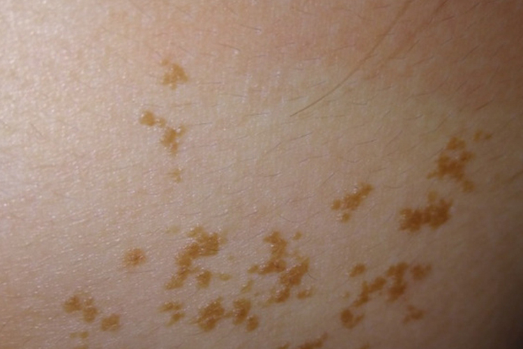 腰部扁平疣图 腰部扁平疣图