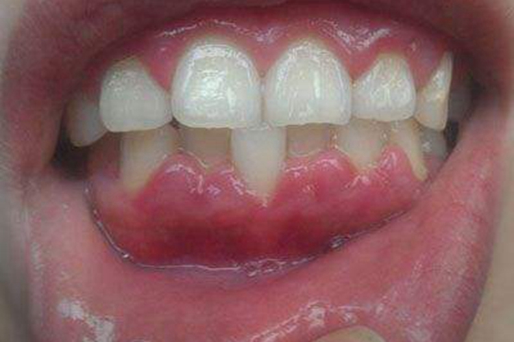 慢性龈炎下边牙龈肿起来了图