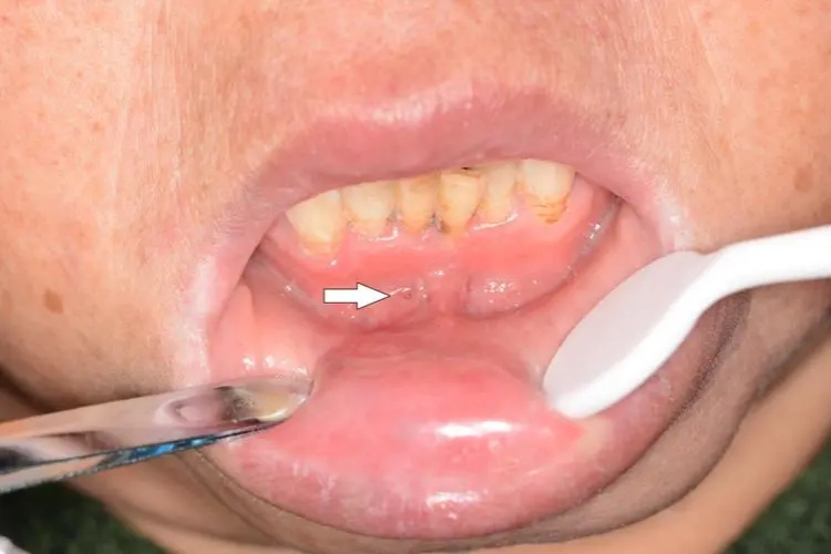 急性浆液性根尖周炎包块图