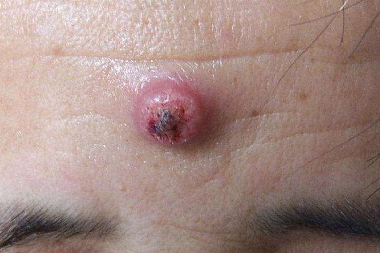 发疹型角化棘皮瘤糜烂图 发疹型角化棘皮瘤糜烂图