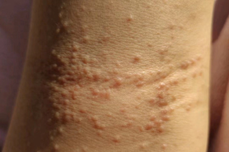 急性湿疹胳膊上好多小丘疹图