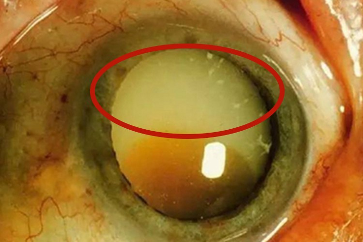 玻璃体疝水肿图 玻璃体疝水肿图