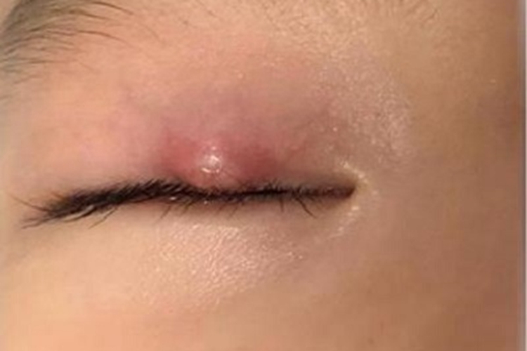 皮脂腺上皮瘤眼睑症状图