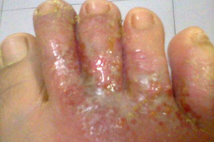 足癣长水疱发炎化脓图