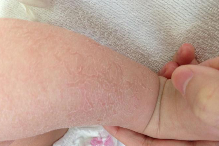 皮肤干燥症腿部裂纹图