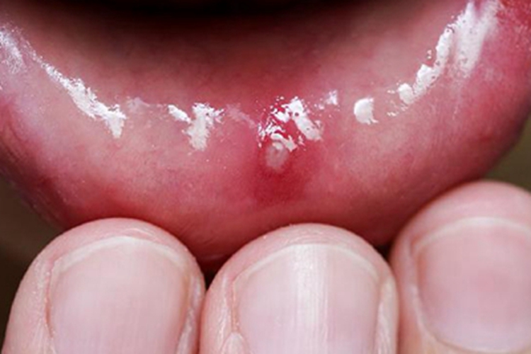 水疱型口腔扁平苔藓小水疱图