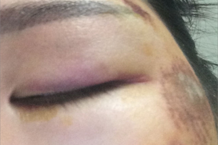 挫伤脸上多处青紫图