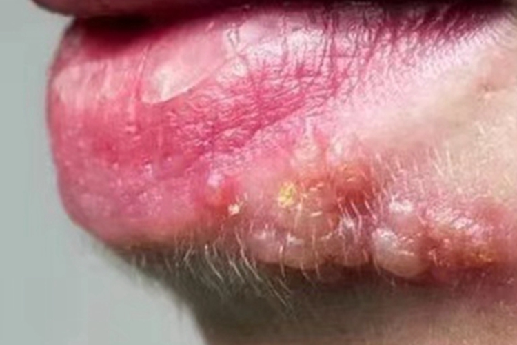 复发性口腔单纯性疱疹水疱图 复发性口腔单纯性疱疹水疱图