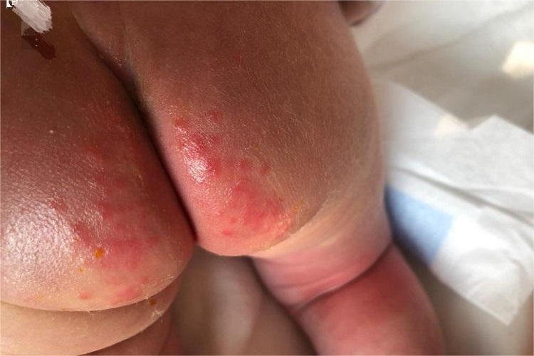渗出型婴儿湿疹臀部红点图 渗出型婴儿湿疹臀部红点图