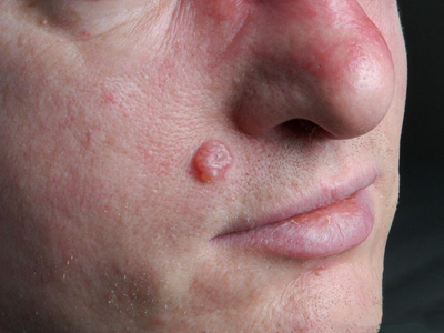 毛囊痣面部长圆疙瘩图