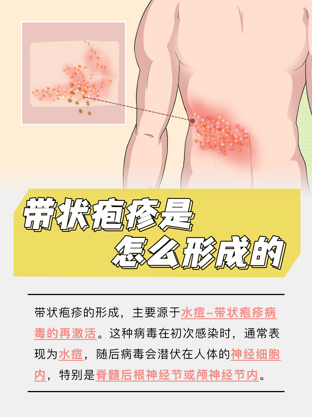 揭秘：带状疱疹是怎么形成的