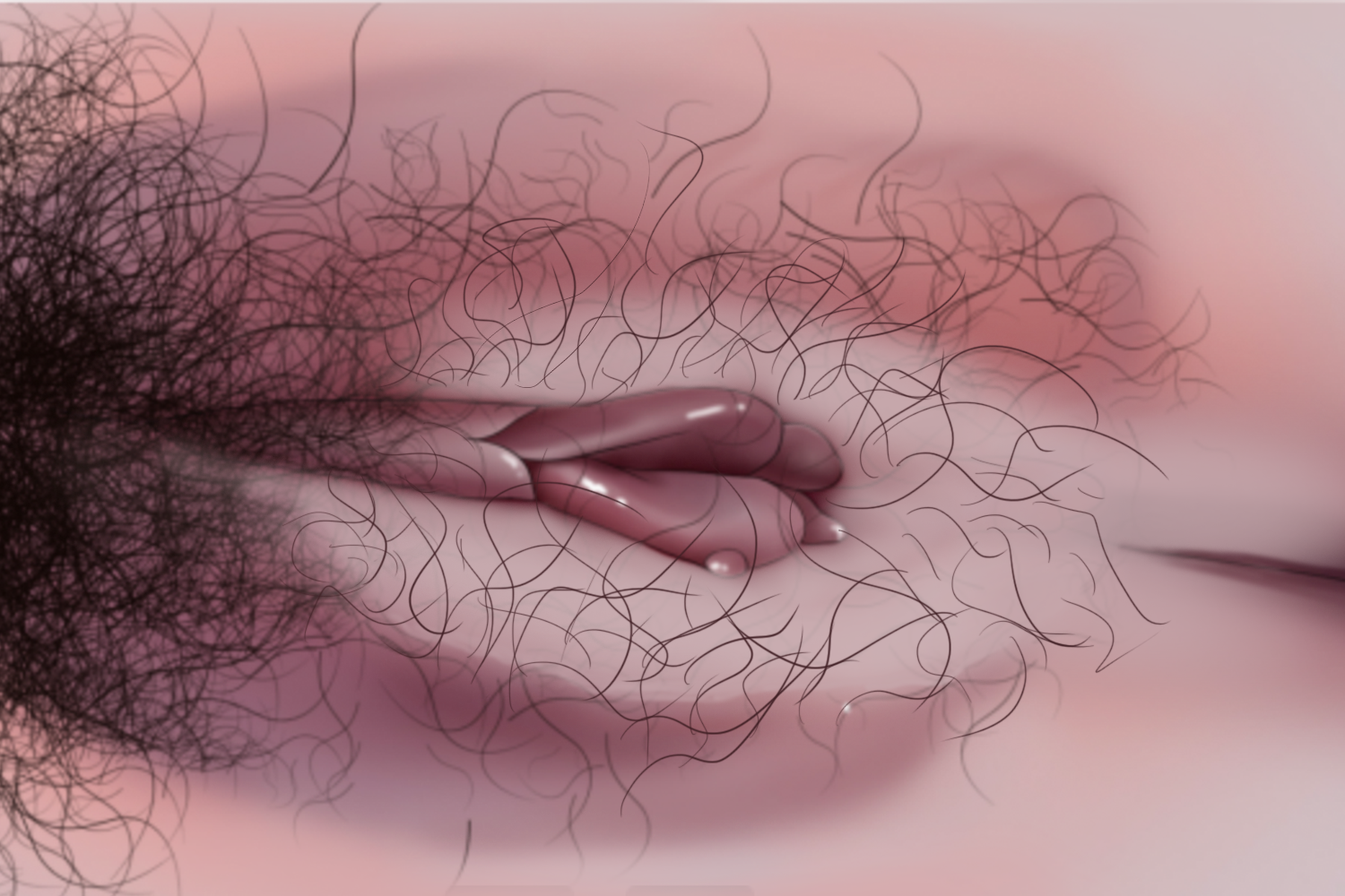 增生型外阴营养不良手绘图 增生型外阴营养不良手绘图