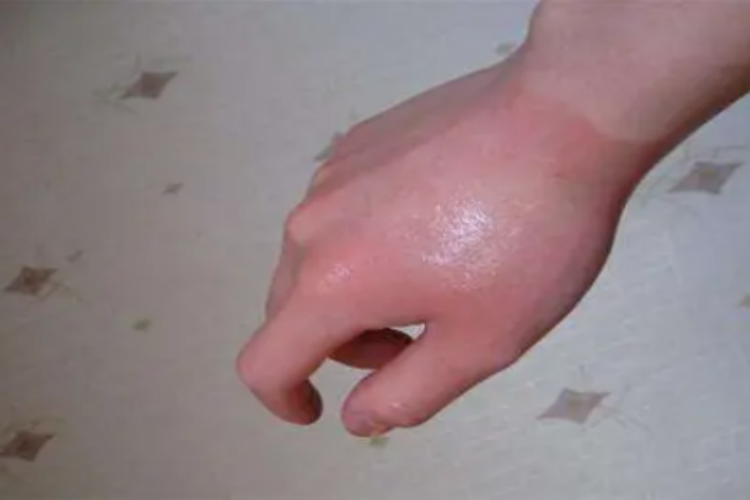 一度烫伤手指发红图