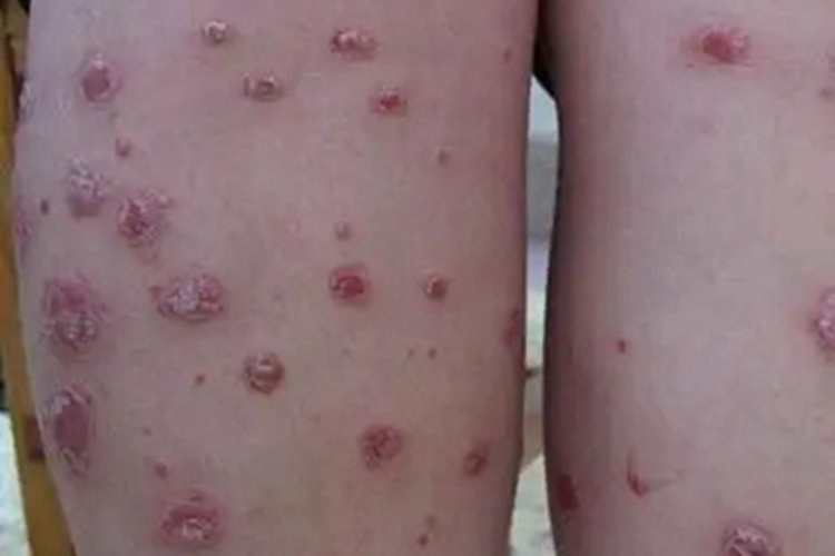 皮肤基底细胞癌小腿斑块图 皮肤基底细胞癌小腿斑块图