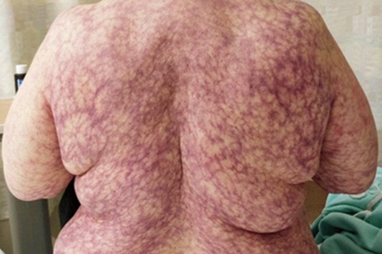 继发性网状青斑图 继发性网状青斑图