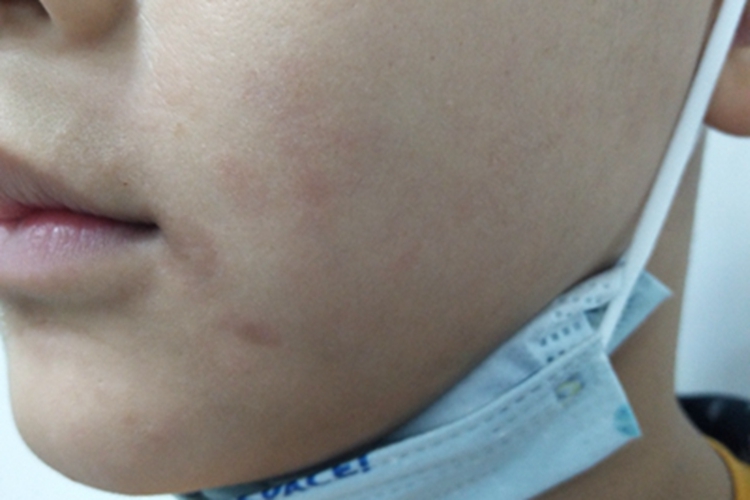 慢性湿疹面部斑图