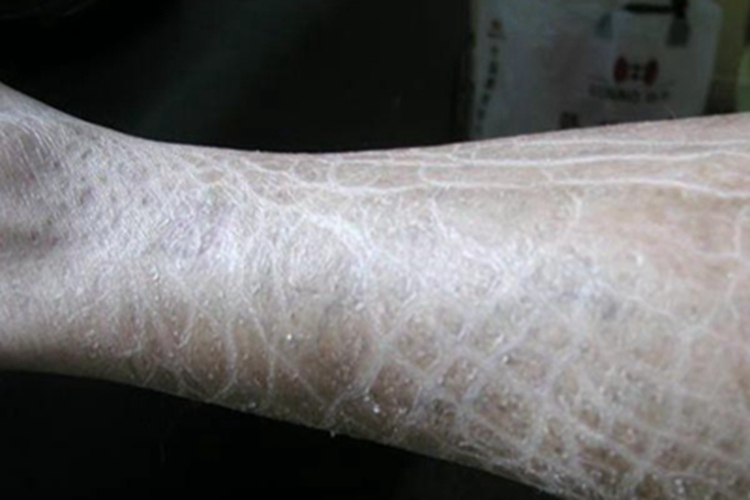 桥本甲状腺炎小腿裂纹图