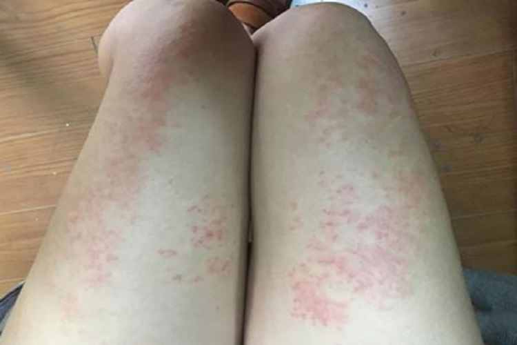 瘰疬性苔藓大腿症状图