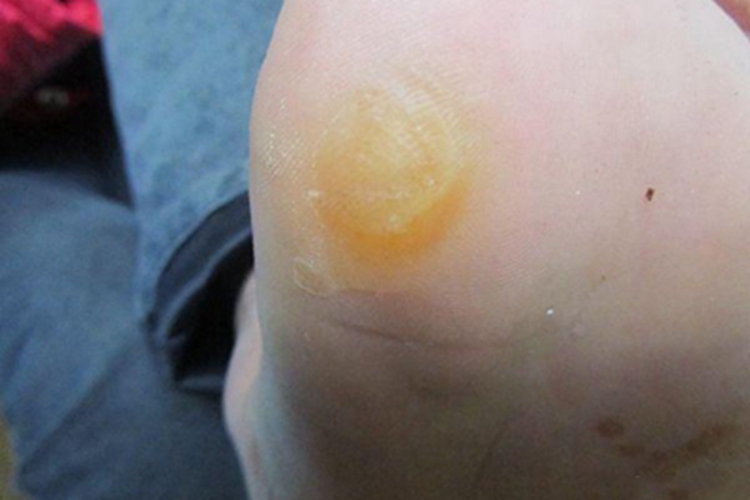 胼胝脚底有黄色增厚图