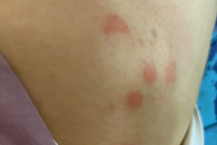 过敏性皮炎大腿部有大疙瘩图