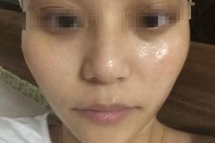 色素性黑眼圈图