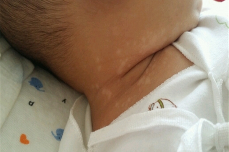 三个月宝宝身上花斑癣图 三个月宝宝身上花斑癣图