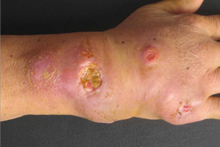 偶遇分枝杆菌感染手腕症状图