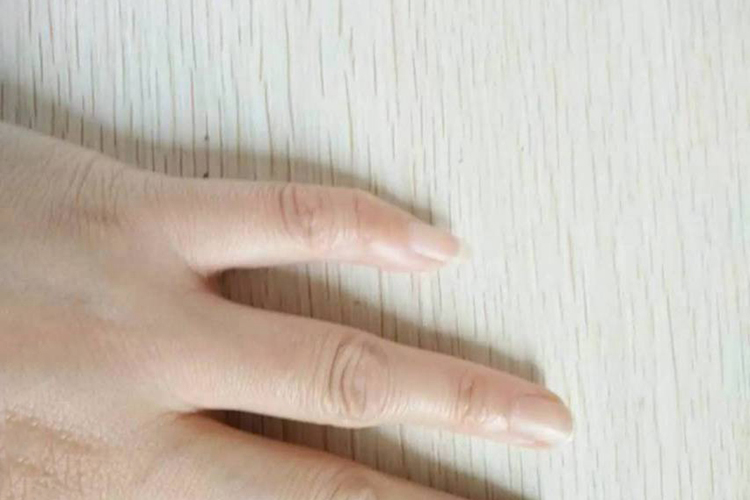 腱鞘炎图 腱鞘炎图