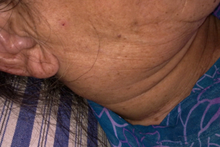 艾滋病急性感染期侧颈淋巴结肿图