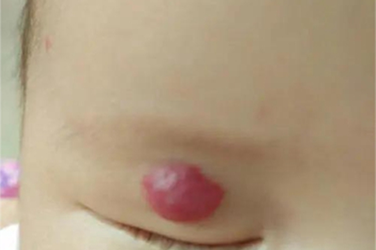 血管瘤眼睑大疙瘩图