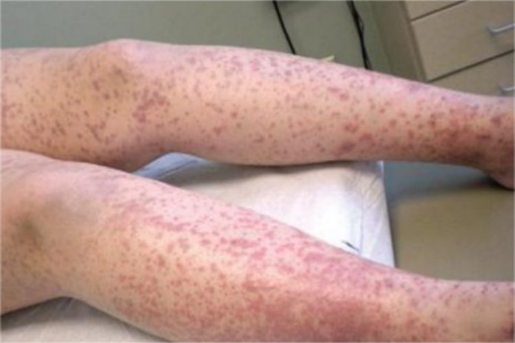 血小板增多性紫癜小腿紫斑图