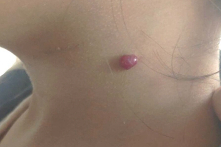 化脓性肉芽肿侧颈疙瘩图