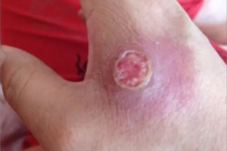 皮肤利什曼病症状图