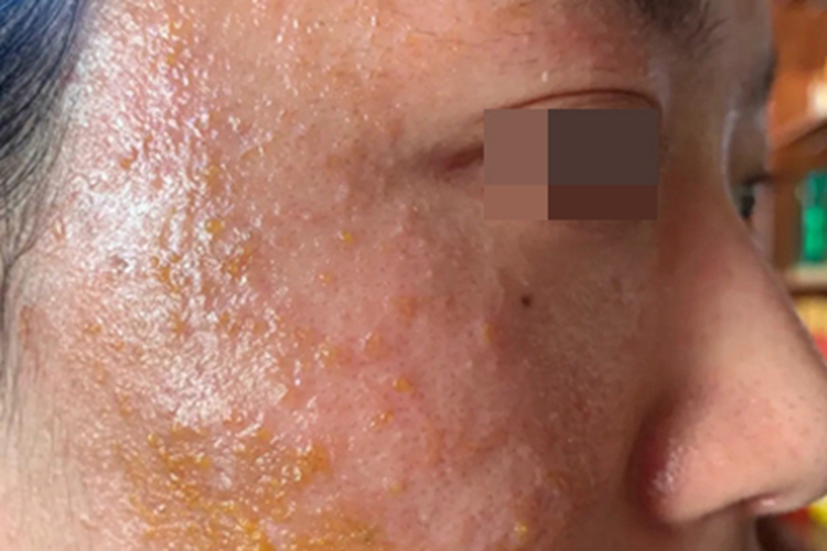 糖皮质激素依赖性皮炎脓包图