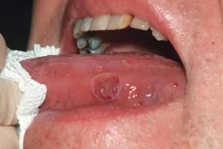 一期口腔梅毒舌侧坑图