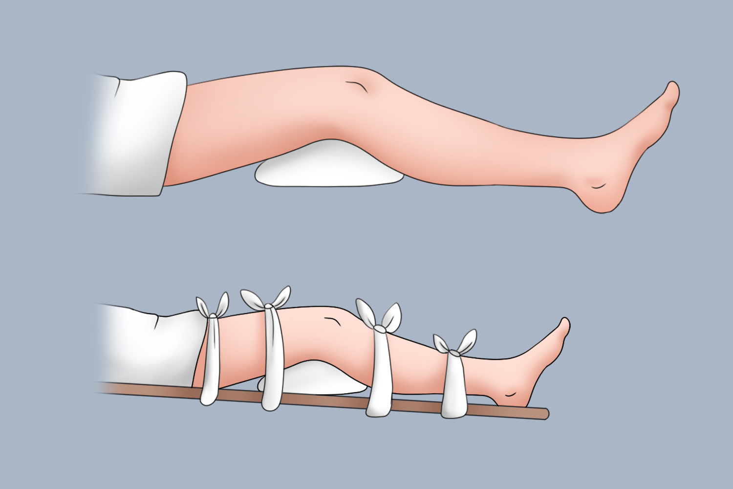 膝盖骨折包扎图 膝盖骨折包扎图