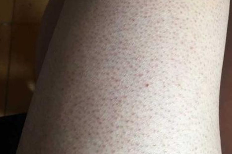 腿上毛周角化症图